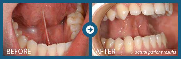 Frenectomy Memphis Tn Periodontal Associates Of Memphis 