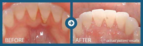 Gum Graft Memphis Soft Tissue Grafting Periodontal Associates Of Memphis