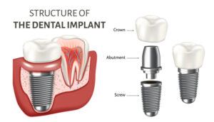 dental implant structure