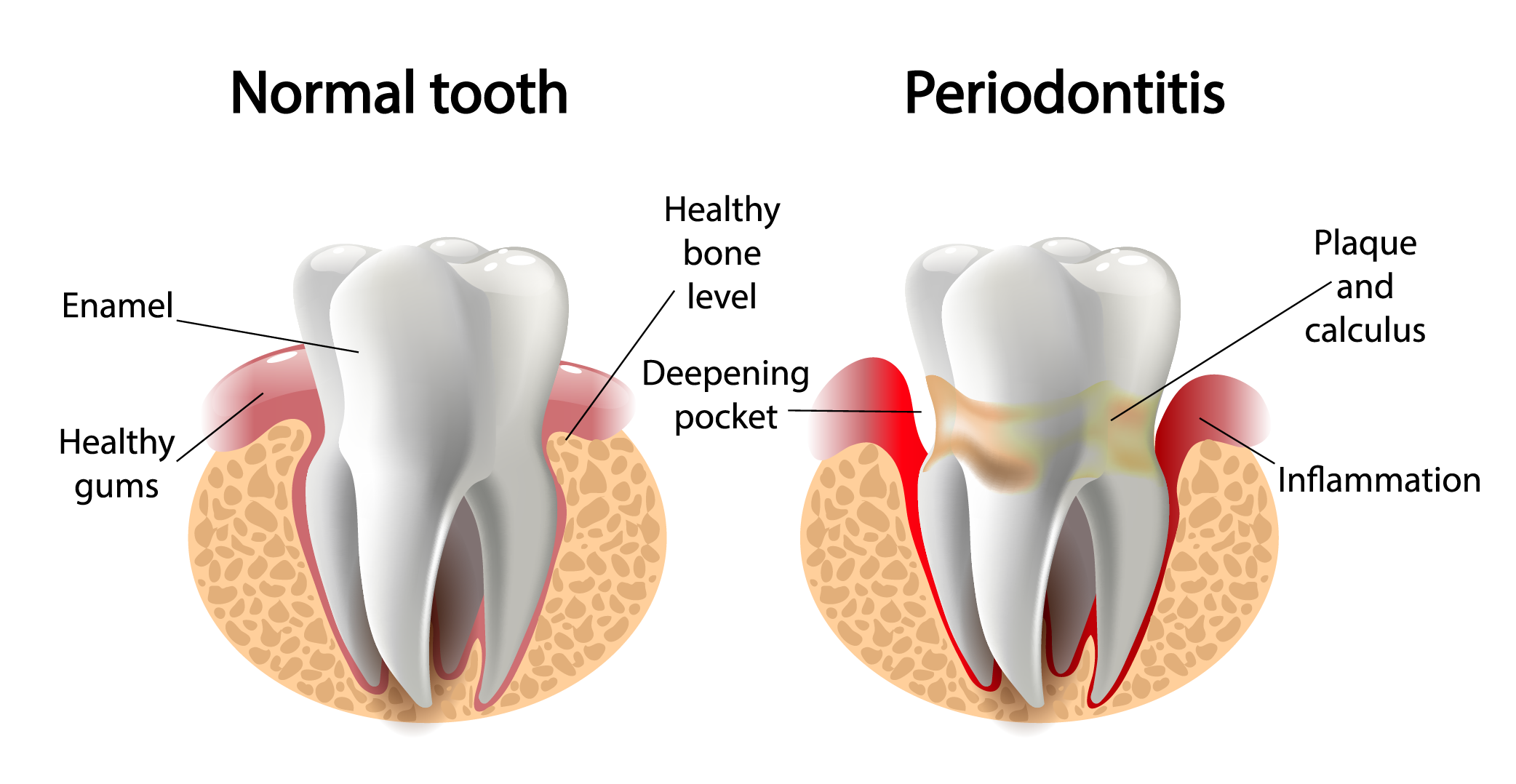 111Periodontal Disease Graphic