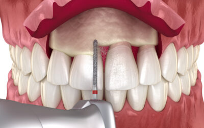 Crown Lengthening for Restorative Success: Saving Damaged Teeth the Smart Way