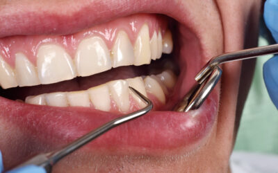 Periodontal Maintenance vs. Regular Cleanings—What’s the Real Difference?