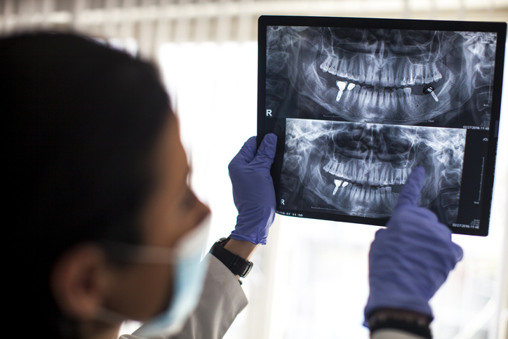 Understanding Implant Dentistry: How an Implant Dentist Can Restore Your Smile