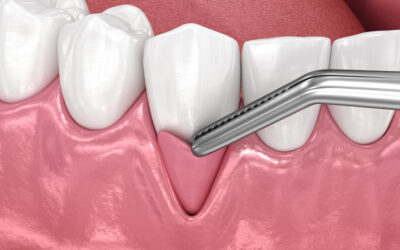 Gum Recession Treatment: Protecting Your Smile from Further Damage