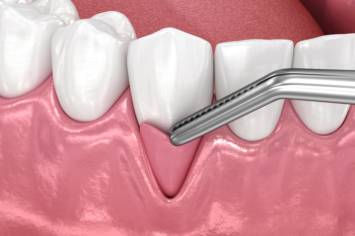 Gingiva Recession: Soft tissue graft surgery. 3D illustration of treatment.