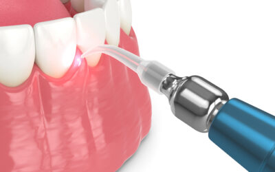 Alternatives to Gum Surgery: Non-Surgical Gum Disease Treatments