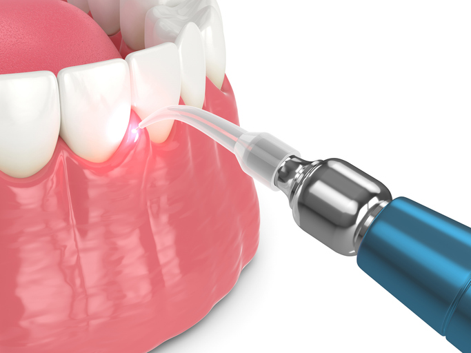 Alternatives to Gum Surgery: Non-Surgical Gum Disease Treatments