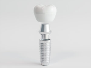 Dental implant with titanium screw and ceramic crown.