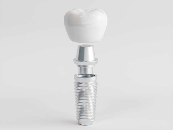 How Long Do Dental Implants Really Last? Lifespan, Risks, and Care