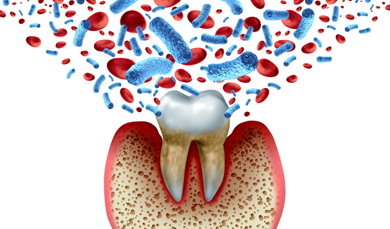 3D illustration of gum recession, tooth decay, blood, and bacteria as a result of periodontitis.