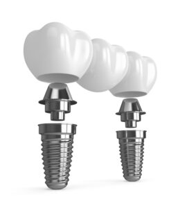 3d render of implants with dental bridge over white background