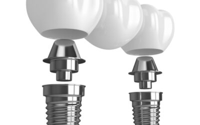 Single Tooth Implant vs Bridge: Pros, Cons, and Pricing