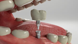 Illustration of dental implant placement.