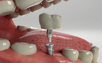 Can You Get Dental Implants If You Have Gum Disease?