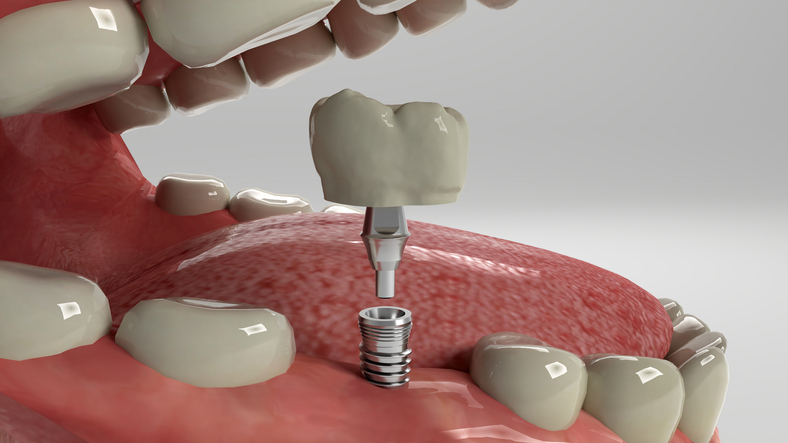 Can You Get Dental Implants If You Have Gum Disease?