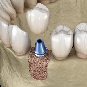 Illustration of a dental implant and crown being placed in grafted jawbone