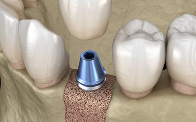 What Happens If You Skip the Bone Graft After an Extraction?