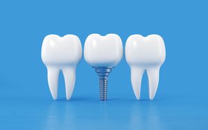 Teeth sitting next to dental implant on blue background,