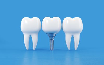 What Does a Dental Implant Actually Cost, and Why Does the Range Vary So Much?